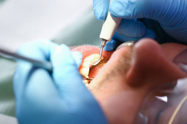 Best Dental Abscess Treatment in West Mountain, UT