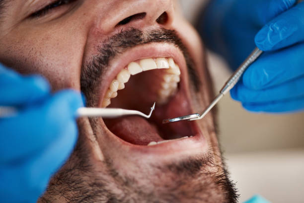 Best Emergency Wisdom Tooth Extraction in West Mountain, UT